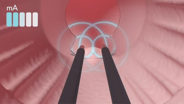 eXroid Procedure Detail